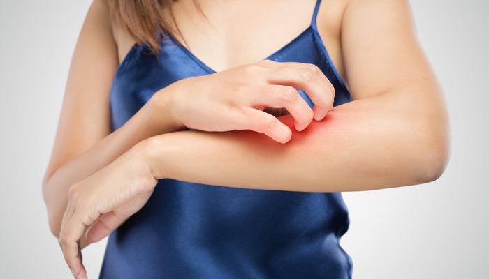 Uyuz hastalığı neden olur? Uyuz hastalığına ne iyi gelir?