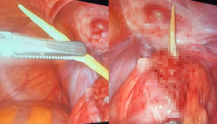 Karın ağrısı altında glutry! Türkiye'de sadece 3 kişi bu davayı gördü …