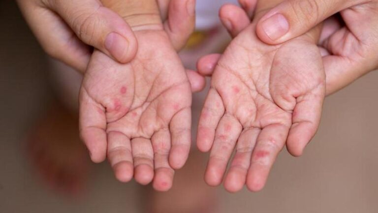 Manuel ayak hastalığının belirtileri nelerdir? El ayak hastalığı nasıl anlaşılır? Tedavi yöntemleri nelerdir?