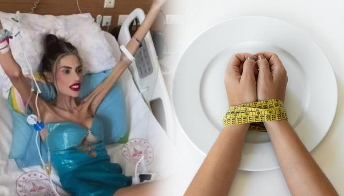 Ölümcül bir psikolojik bozukluk değil, aç bir hastalık değil! Anoreksiya nevroza nedir? Anoreksiya nasıl tedavi edilir?