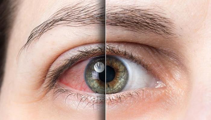 Göz sağlığını hafife almayın! Son olarak şikayetleri yakmak ve yakmak için: “Kuru göz hastalığı yaşam kalitesini azaltır”