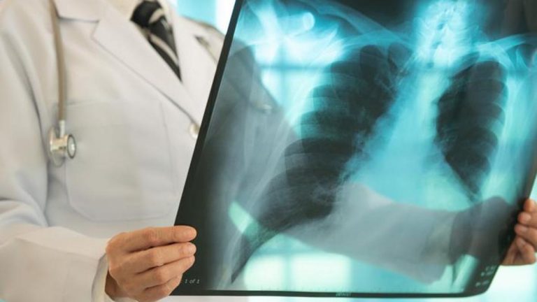 Erken teşhis önemli! Akciğer kanserinin belirtileri nelerdir? Öksürük, göğüs ağrısı, halsizlik, balgamda kan… –